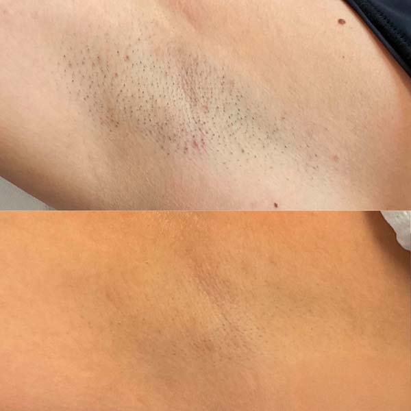 Elementes tsideor #9421 9 Permanent hårfjerning - førefter.zip - 4