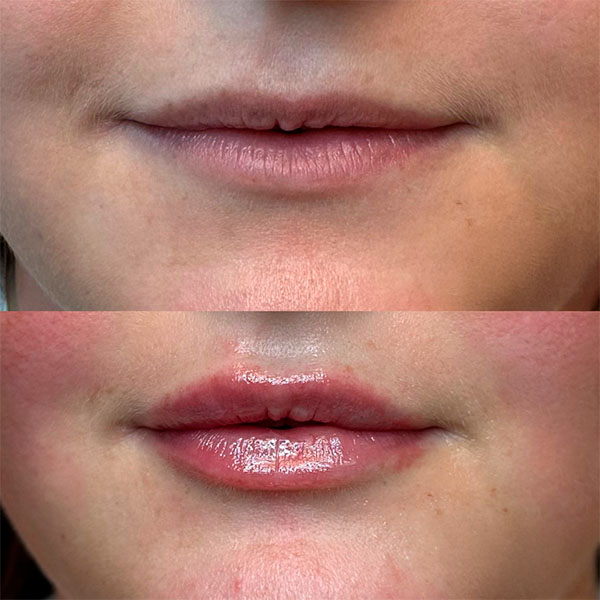 Elementes tsideor #9421 10 filler lip klinik la cour