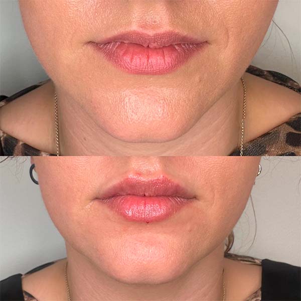 Elementes tsideor #9421 5 læbebehandling klinik la cour