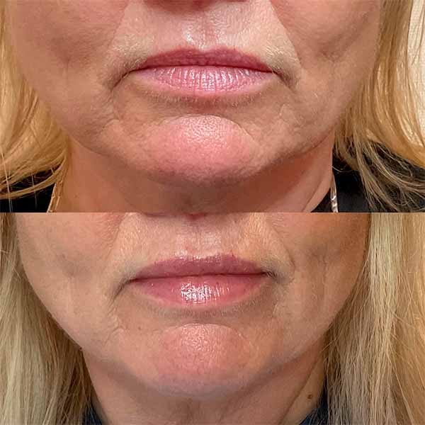 Elementes tsideor #9421 6 lipflip