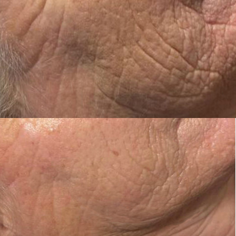 Forside | Klinik La Cour 8 Seveny Hyal 2000