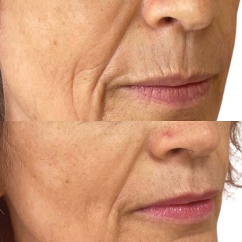 Forside | Klinik La Cour 12 Viscoderm Skinko è