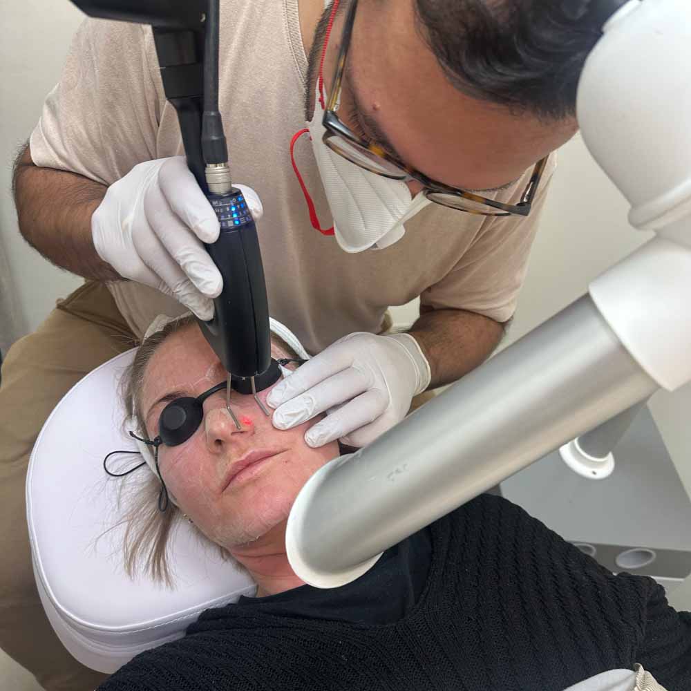 Fraktioneret CO2 laser 3 fraktioneret co2 laser