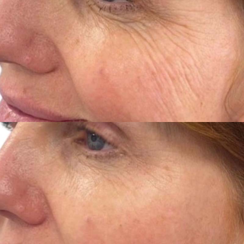 Forside | Klinik La Cour 10 Profhilo Structura