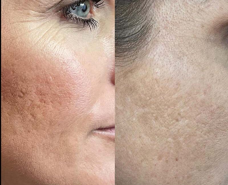 Forside | Klinik La Cour 4 restylane skinbooster