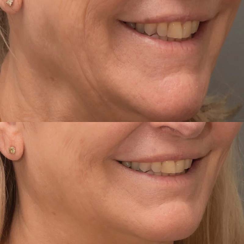 viscoderm 2 behandlinger