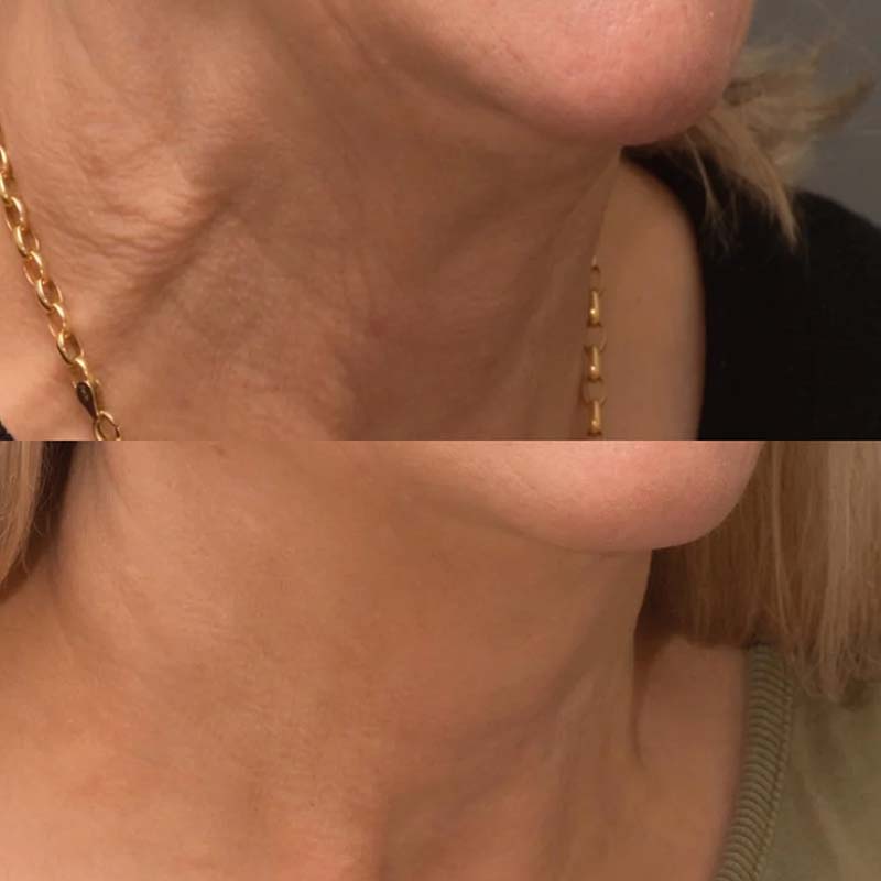 Forside | Klinik La Cour 11 Viscoderm Skinbooster