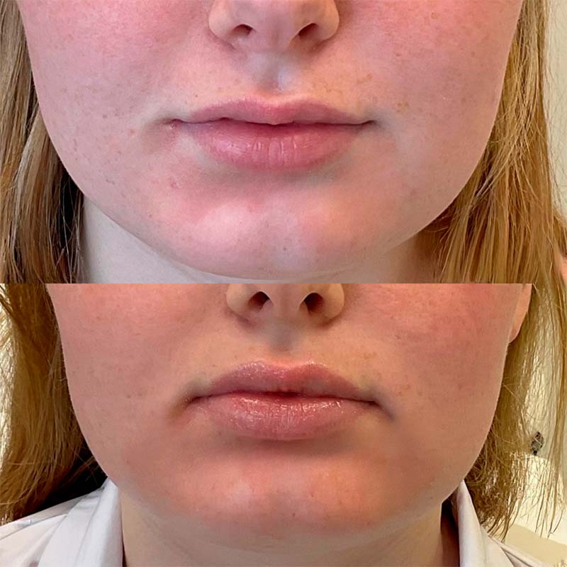 Forside | Klinik La Cour 1 Lipflip med