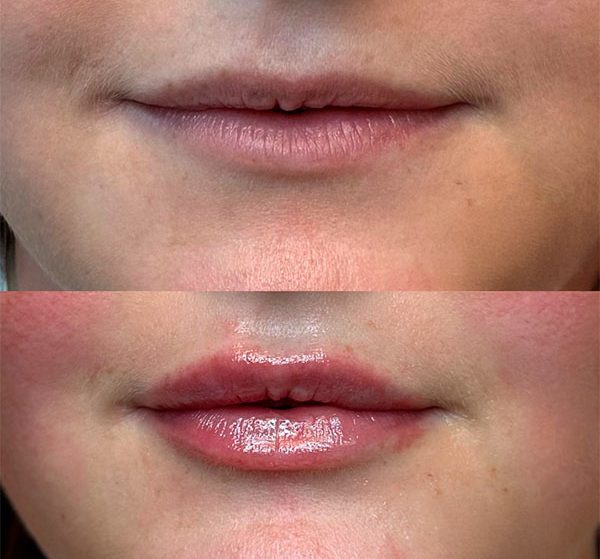 filler lip klinik la cour